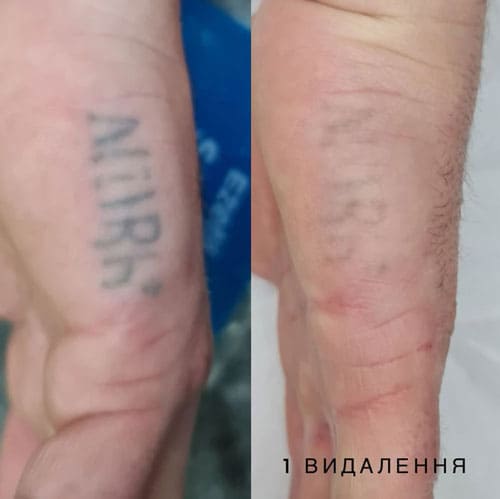 Лазерное удаление тату в Киеве